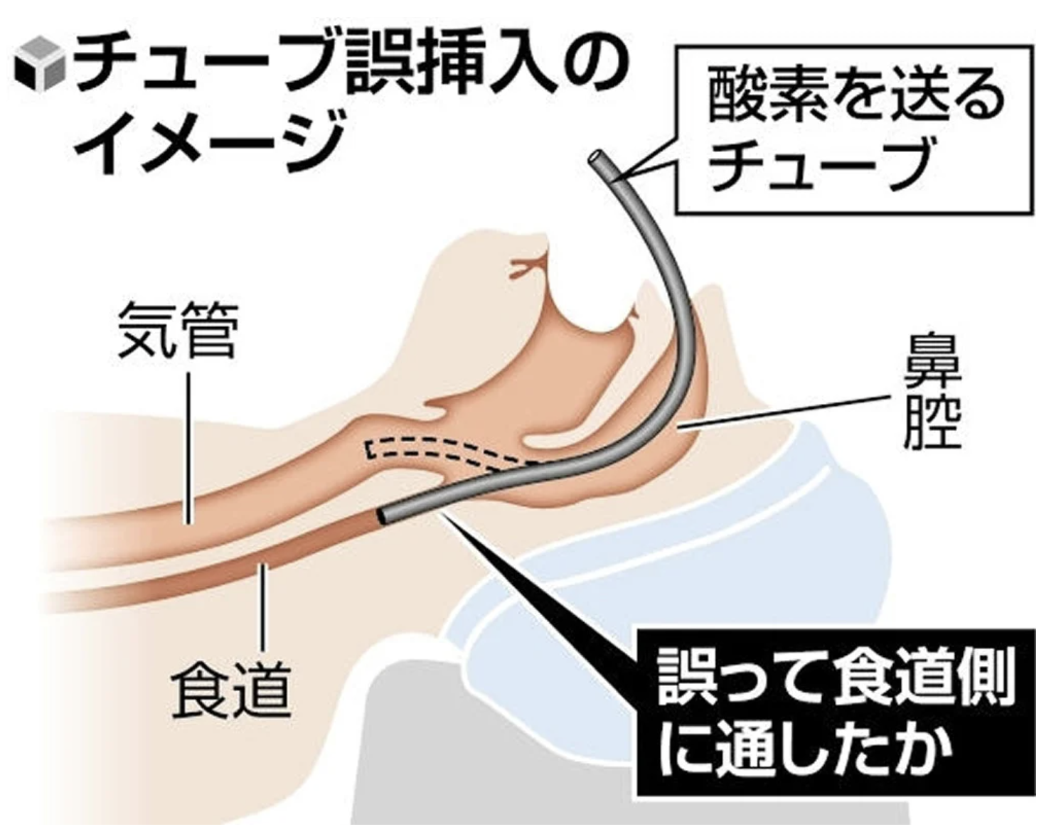 まさか「抜歯で亡くなるなんて…」支援学校生死亡の真相とは？